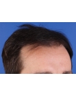 Before Hair Transplant&nbsp;Hairlines